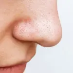 Get Rid Of Blackheads And Enlarged Pores: A Complete Guide to Clearer Skin