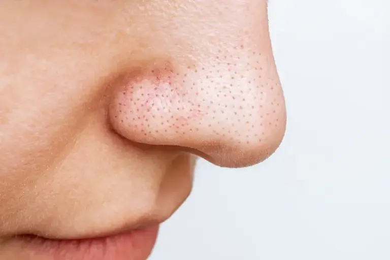Get Rid Of Blackheads And Enlarged Pores: A Complete Guide to Clearer Skin