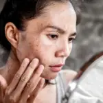 Here S How To Prevent Hyperpigmentation In The Summer Naturally