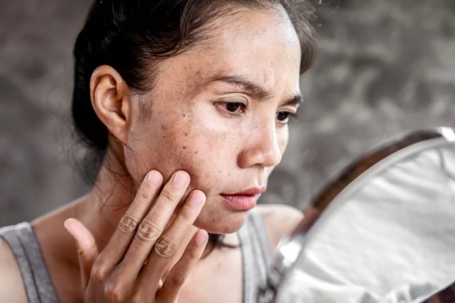 Hyperpigmentation