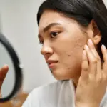 How To Deal With Acne And Pigmentation For Combination Skin: A Complete Skin Care Guide