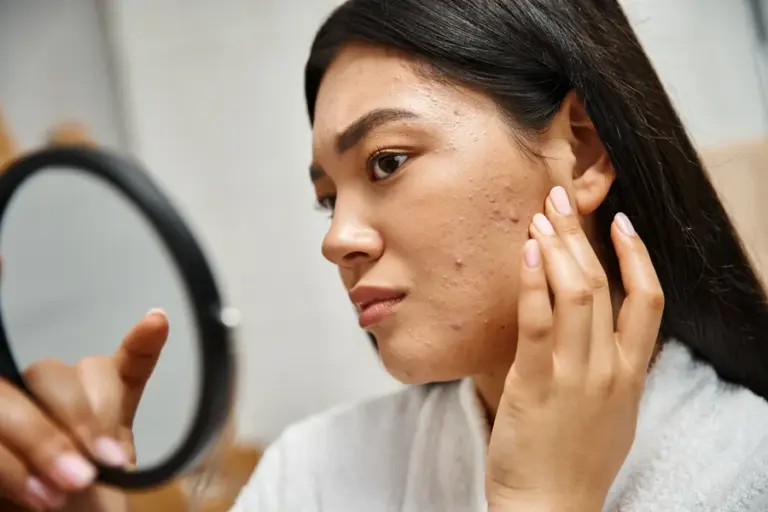 How To Deal With Acne And Pigmentation For Combination Skin: A Complete Skin Care Guide