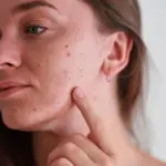 How To Deal With Acne And Pigmentation For Sensitive Skin: A Complete Guide to Healthier Skin