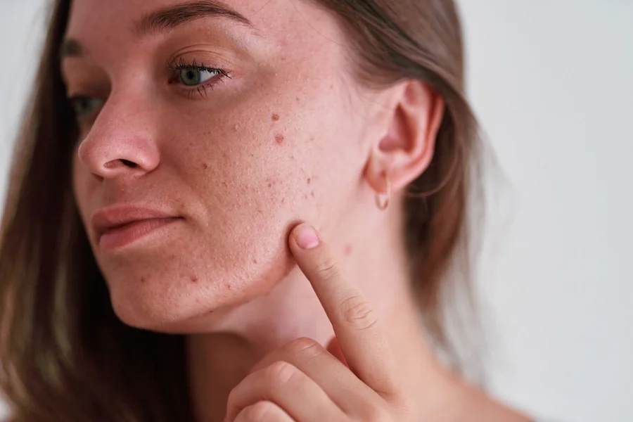 How To Deal With Acne And Pigmentation For Sensitive Skin