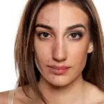 How To Get Rid Of Acne Scars Here Is What Experts Say for Healthier Smoother Skin