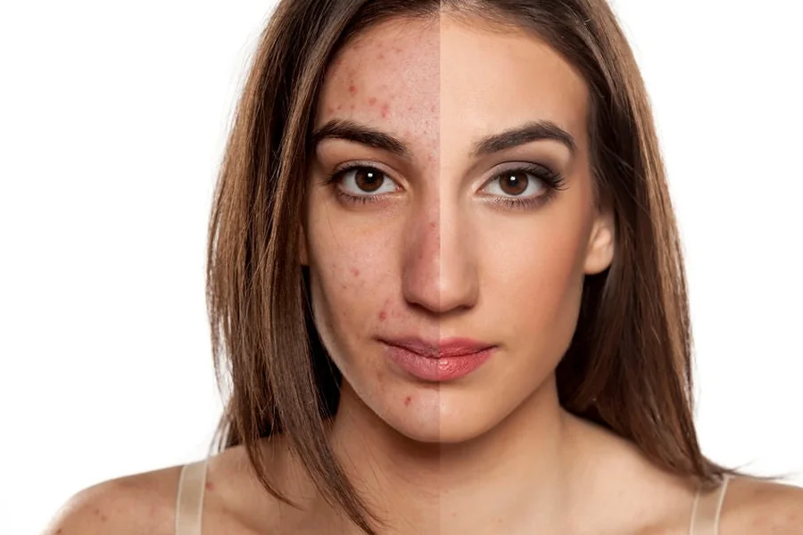 How To Get Rid Of Acne Scars Here Is What Experts Say
