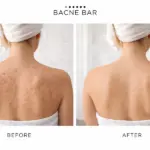 How To Get Rid Of Back Acne with Simple Daily Habits