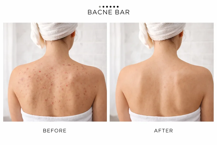 Back Acne