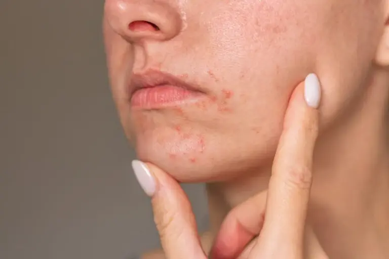 How To Treat An Allergic Reaction To A Skincare Product with Suganda Skincare
