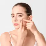 How To Treat Dark Spots Due To Acne and Restore an Even Skin Tone