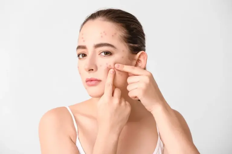 How To Treat Dark Spots Due To Acne and Restore an Even Skin Tone