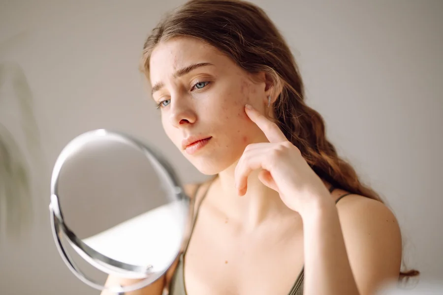 Severe Acne