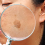 Melasma Dark Patches On Your Skin 1: Causes, Treatment, and Prevention