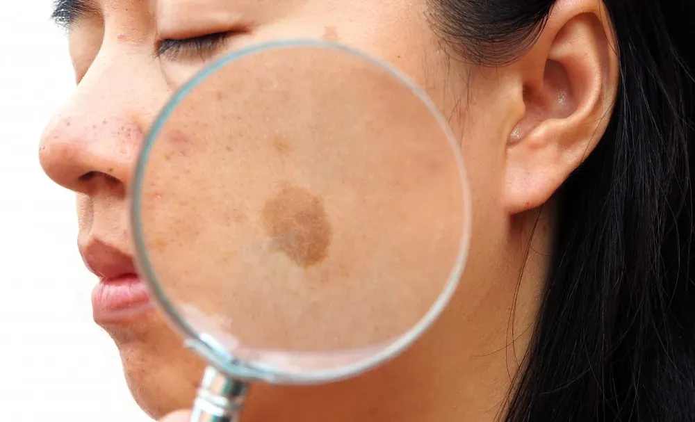 Melasma Dark Patches On Your Skin 1