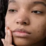 Mental Health Of An Acne Prone Person Everything You Must Know