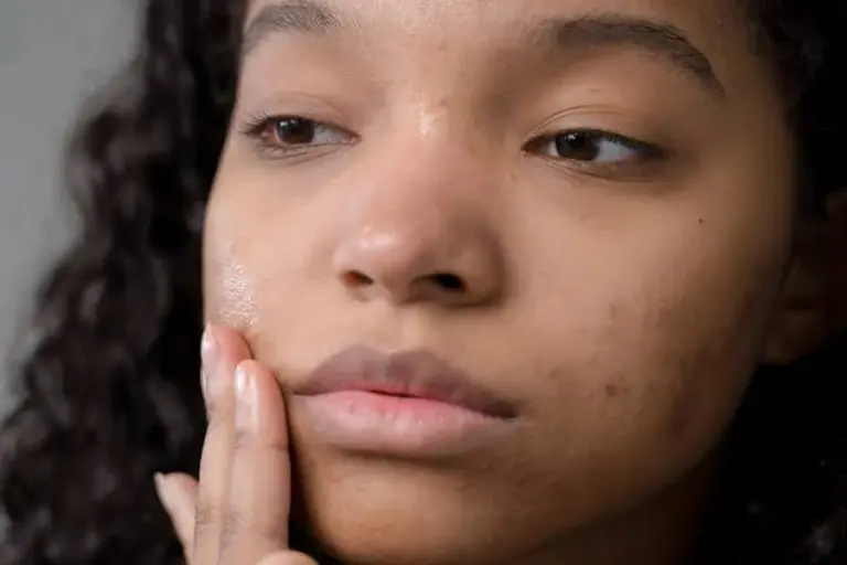 Mental Health Of An Acne Prone Person Everything You Must Know