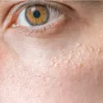 Milia What Are The Milia What Are The Causes And Symptoms Of Milia How To Treat Milia A Complete Skin Health Guide