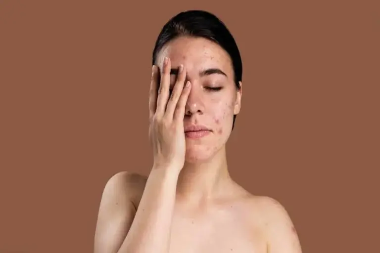 Pigmentation For Oily Skin Causes Treatments and Prevention