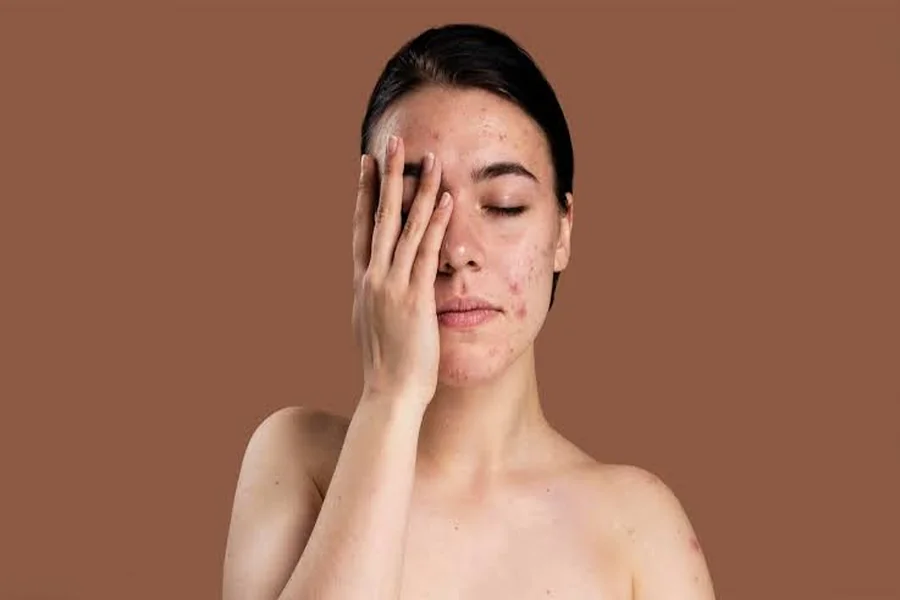 Pigmentation