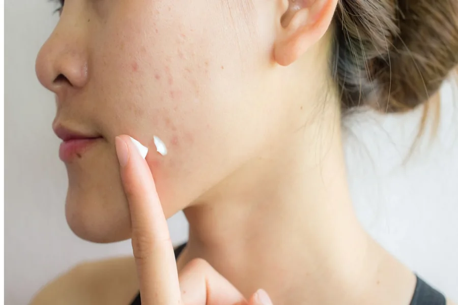 Salicylic Acid