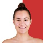 5 Types Of Acne You Should Know About: A Complete Guide to Understanding Types of Acne