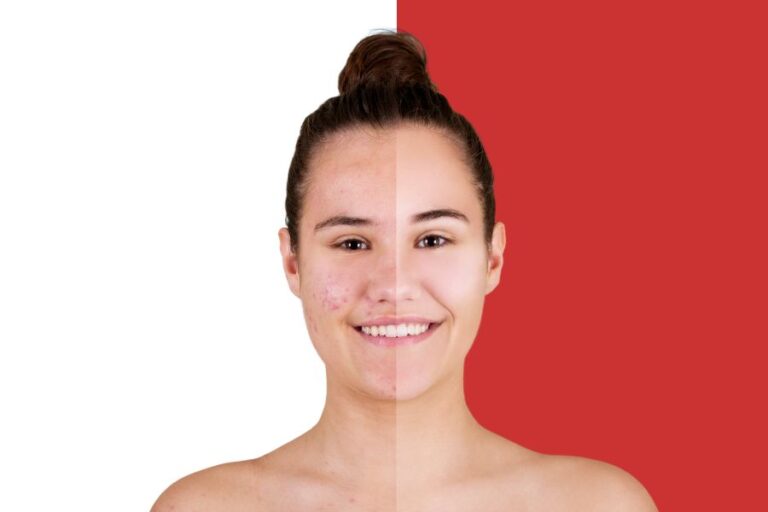 5 Types Of Acne You Should Know About: A Complete Guide to Understanding Types of Acne