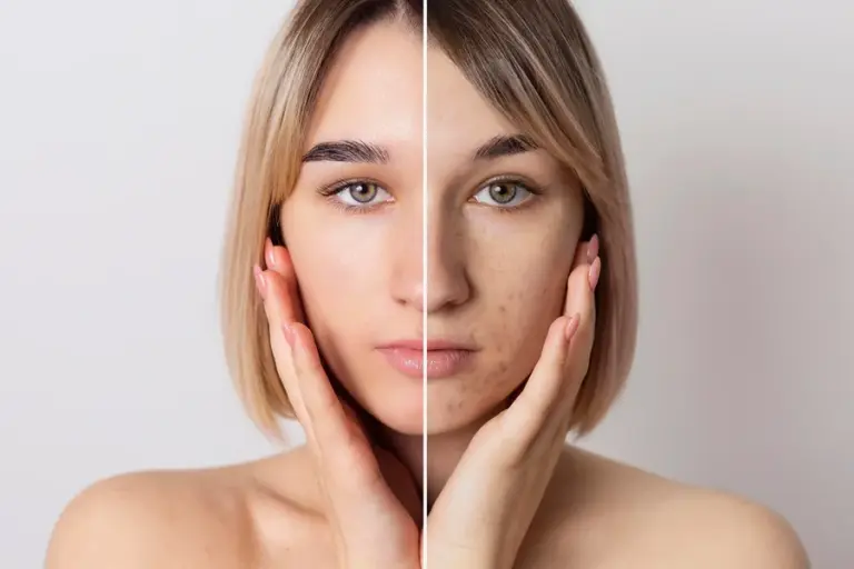 Whats And Whys Hyperpigmentation: A Complete Guide to Understanding Uneven Skin Tone