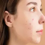 Whats Causing Your Acne Take A Look At These Reasons and Solutions